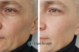 How to Fight Aging Symptoms 3 Fight Aging Symptoms The Potteries With HIFU and Morpheus8 Today!