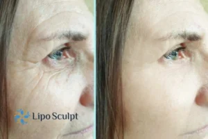 How to Fight Aging Symptoms 2 Do you want to Fight Aging Symptoms The Potteries? Contact Lipo Sculpt today!