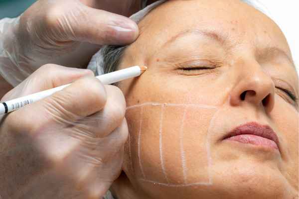 CryoPen: 5 Skin Concerns It May Be Used to Treat 4 What should you ask before having CryoPen treatment The Potteries?