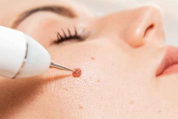CryoPen: 5 Skin Concerns It May Be Used to Treat 3 What actually happens during a CryoPen treatment The Potteries?