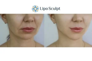 Explaining Total Skin Tightening Treatment And What It Can Do For You 2 Do you want to boost your self confidence? Give Morpheus8 The Potteries a try today!