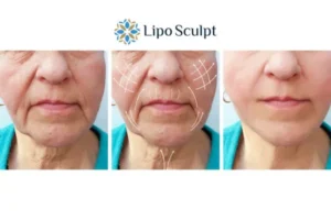 Explaining Total Skin Tightening Treatment And What It Can Do For You 3 Boost your confidence with Morpheus8 The Potteries call our team today!