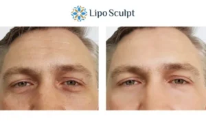 Explaining Total Skin Tightening Treatment And What It Can Do For You 6 Morpheus8 The Potteries book in today to find out more!