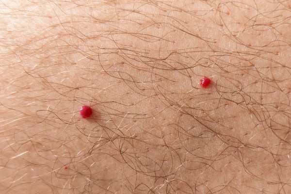 CryoPen: 5 Skin Concerns It May Be Used to Treat 2 cherry angioma removal The Potteries