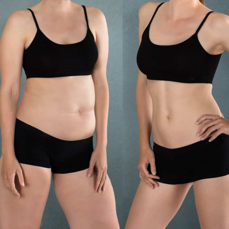 Does Fat Freezing at Home Work? DIY Devices vs Professional Cryolipolysis 2 before and after Cryolipolysis The Potteries