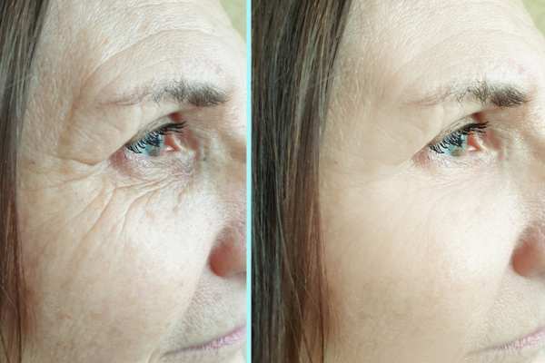 Why Do People Choose HIFU for a Non-Surgical Facelift? 4 How long can HIFU results last The Potteries?