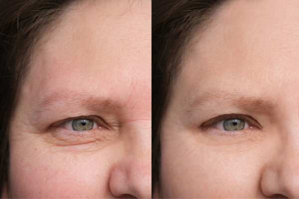 HIFU vs Botulinum Toxin: Understanding the Differences 4 How long do HIFU results last The Potteries?