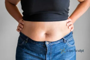Bidding Farewell to Muffin Tops with Aqualyx Fat Injections 2 Do you wish you could reduce your muffin top The Potteries With Aqualy fat dissolving injections you can!